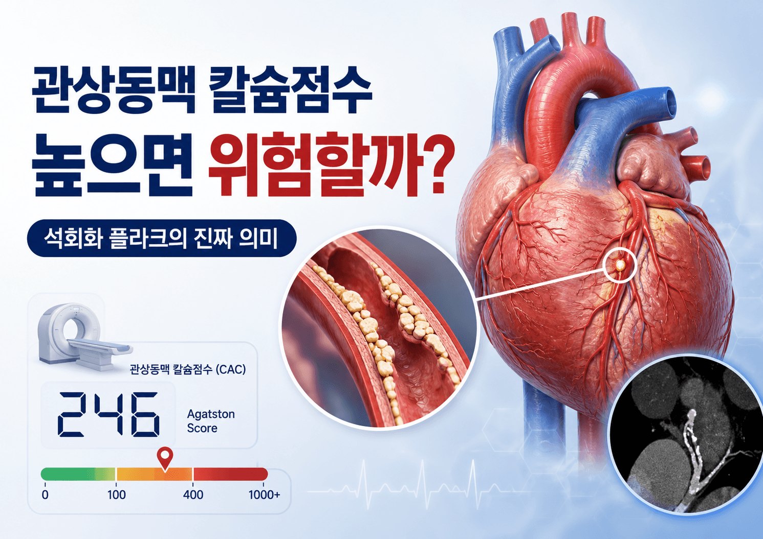 관상동맥 칼슘점수가 높으면 위험할까? CAC 점수와 석회화 플라크의 진짜 의미
