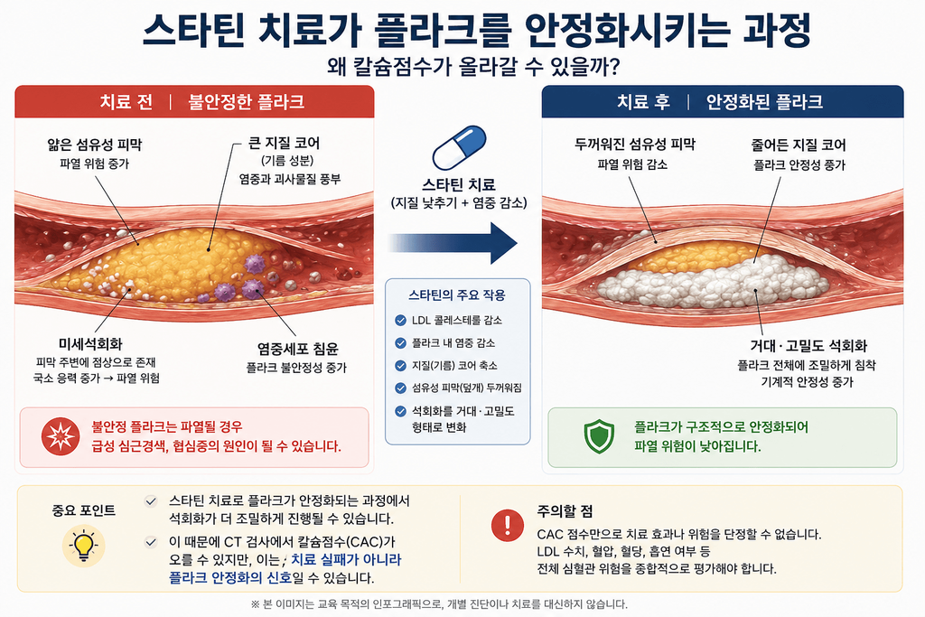 스타틴 치료 전후 관상동맥 플라크 변화와 칼슘점수 증가 가능성을 설명한 인포그래픽