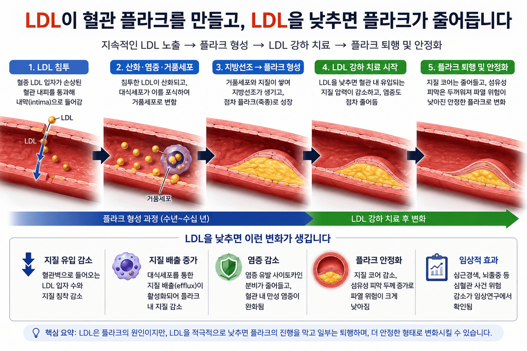 LDL이 혈관벽에 침투해 플라크를 형성하고 LDL 강하 후 플라크가 퇴행·안정화되는 과정