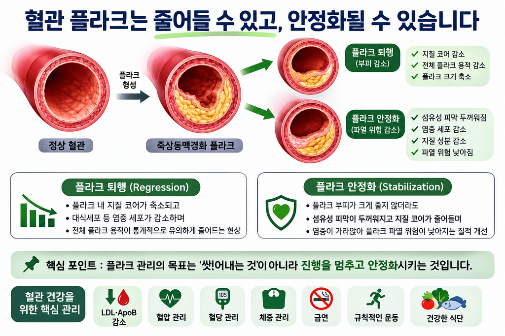 혈관 플라크 줄이는 법과 플라크 퇴행·안정화 차이