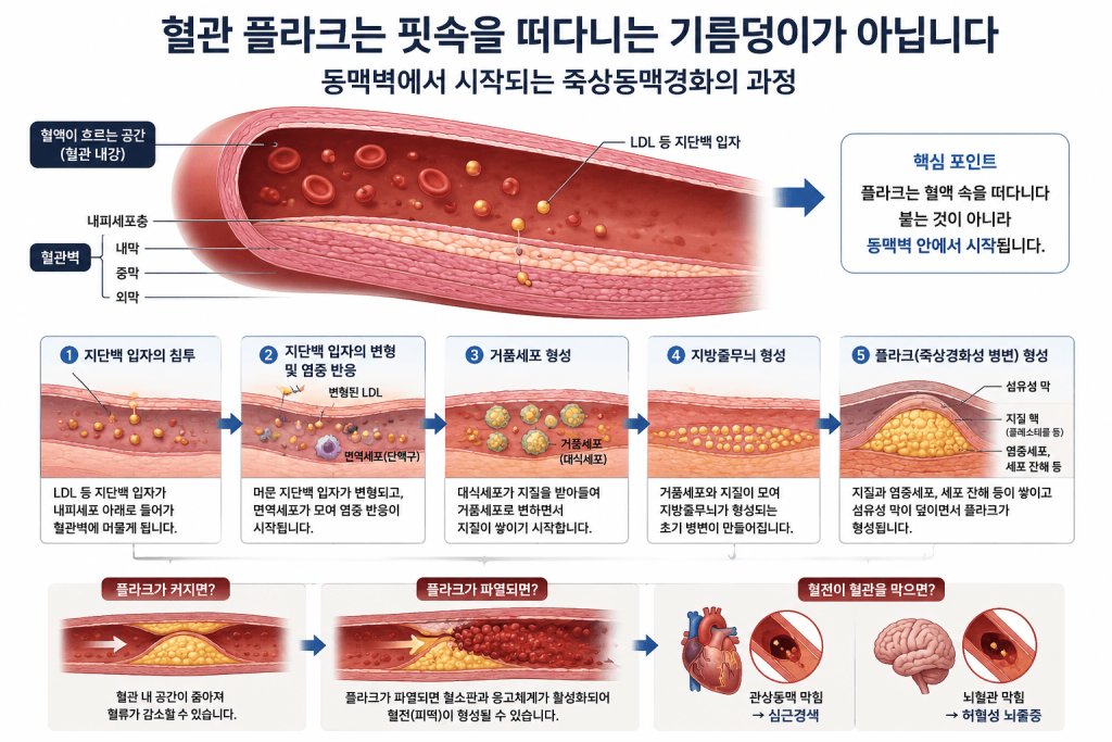 혈관 플라크는 어떻게 만들어질까?