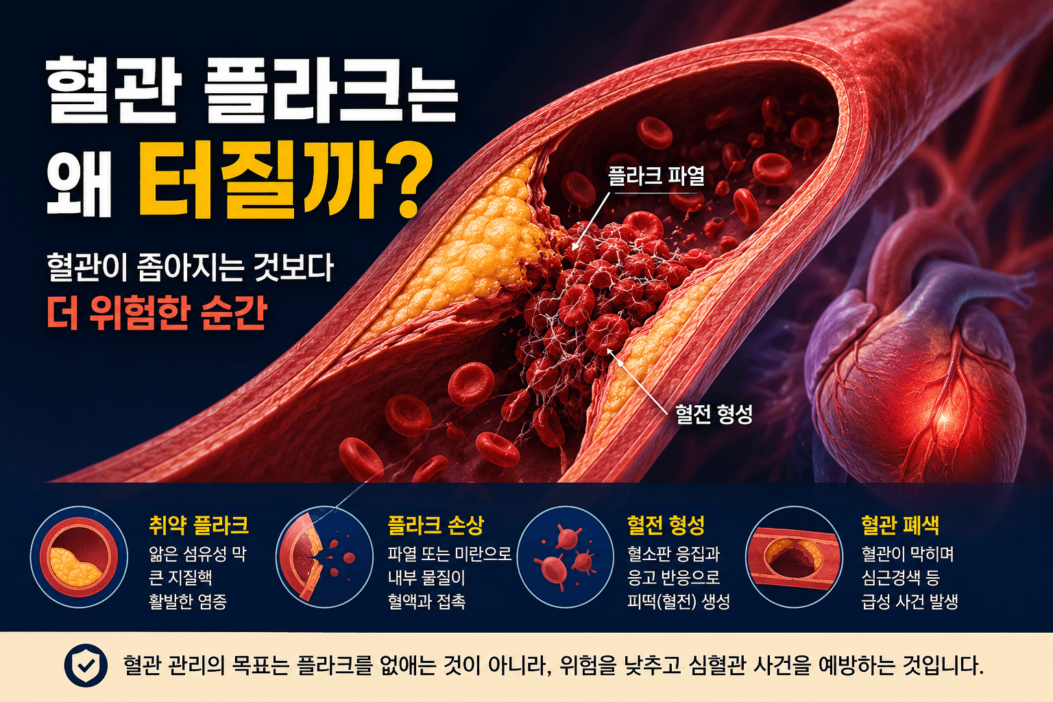 혈관 플라크는 왜 터질까? 혈관이 좁아지는 것보다 더 위험한 순간