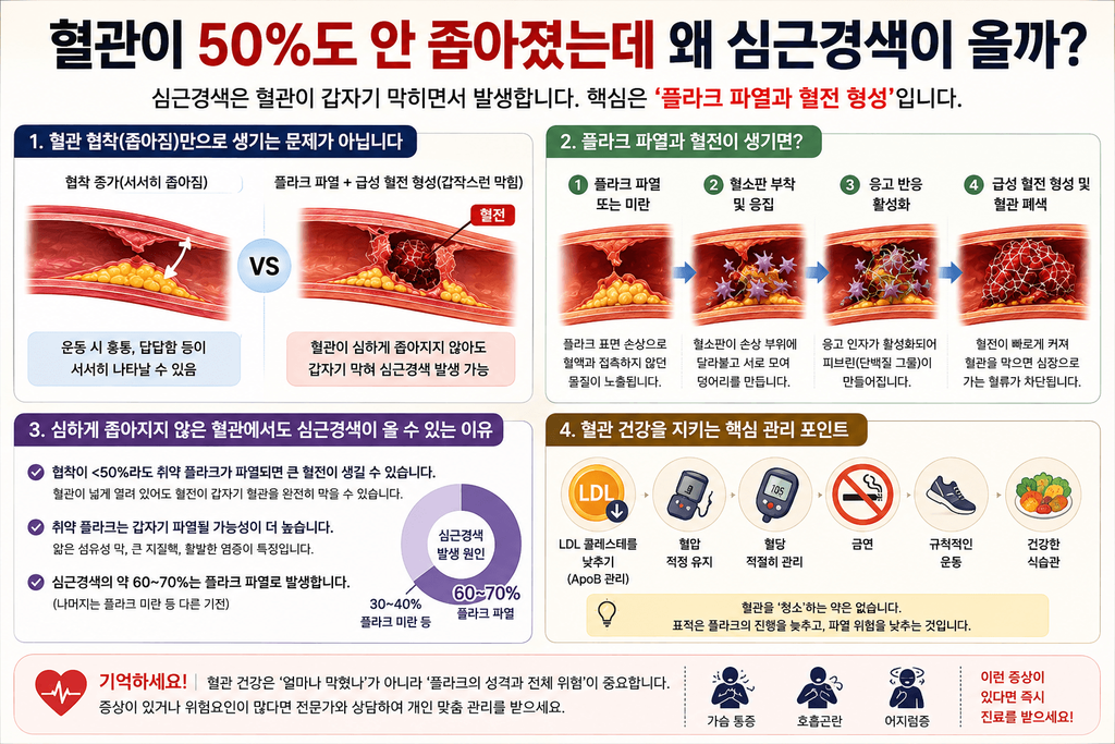 혈관이 50% 미만으로 좁아진 상태에서도 플라크 파열과 혈전 형성으로 심근경색이 발생할 수 있음을 설명하는 인포그래픽