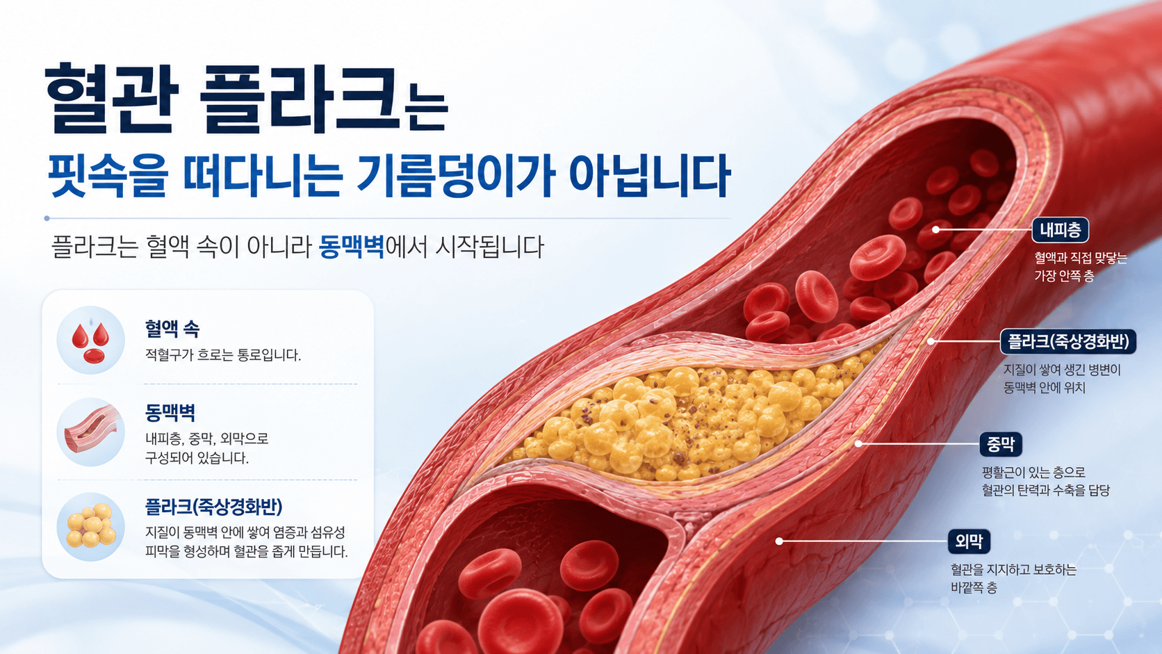 혈관 플라크는 핏속을 떠다니는 기름덩이가 아닙니다
